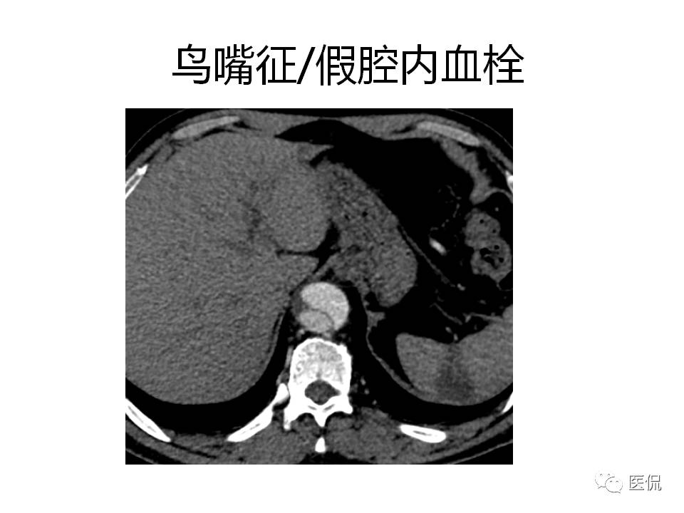 主动脉夹层的影像诊断，这样鉴别更简单！