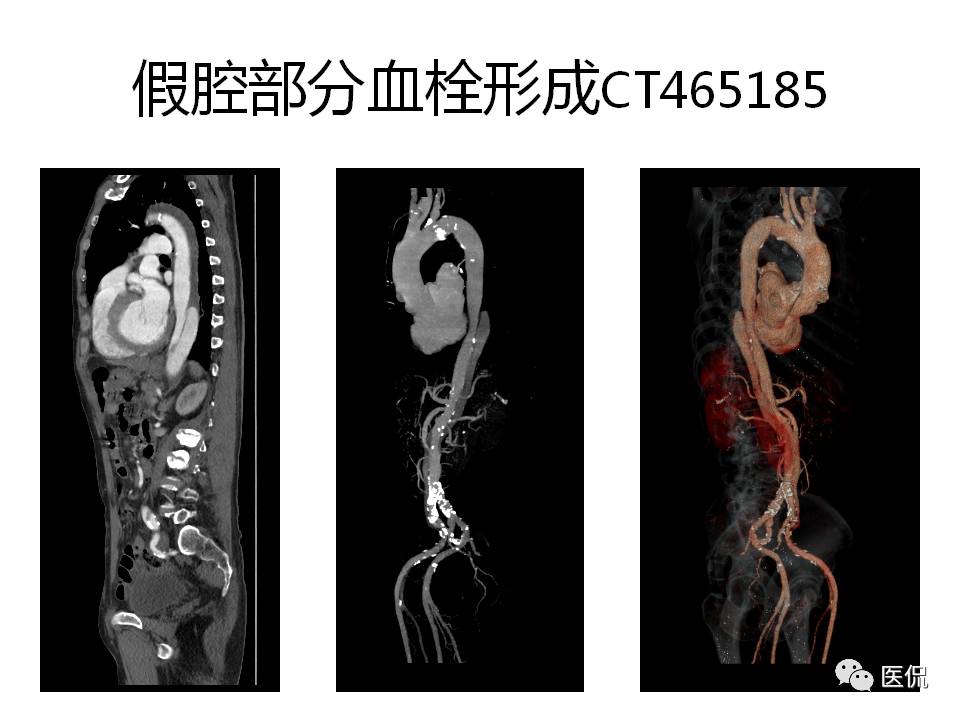 主动脉夹层的影像诊断，这样鉴别更简单！