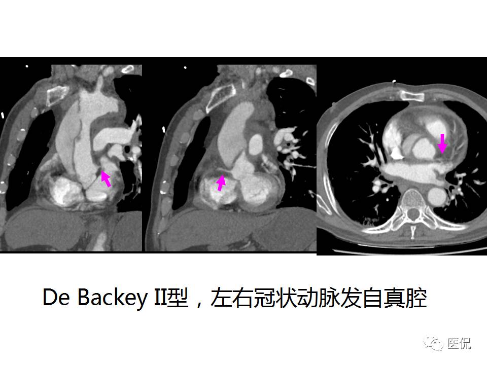 主动脉夹层的影像诊断，这样鉴别更简单！