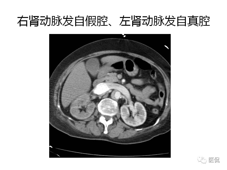 主动脉夹层的影像诊断，这样鉴别更简单！