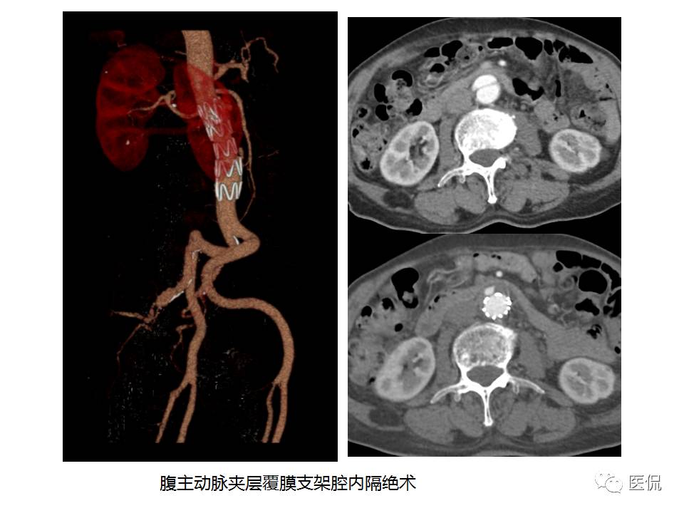 主动脉夹层的影像诊断，这样鉴别更简单！