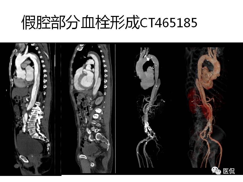 主动脉夹层的影像诊断，这样鉴别更简单！