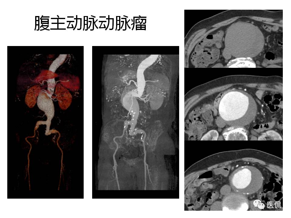 主动脉夹层的影像诊断，这样鉴别更简单！