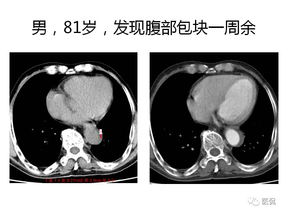 主动脉夹层的影像诊断，这样鉴别更简单！