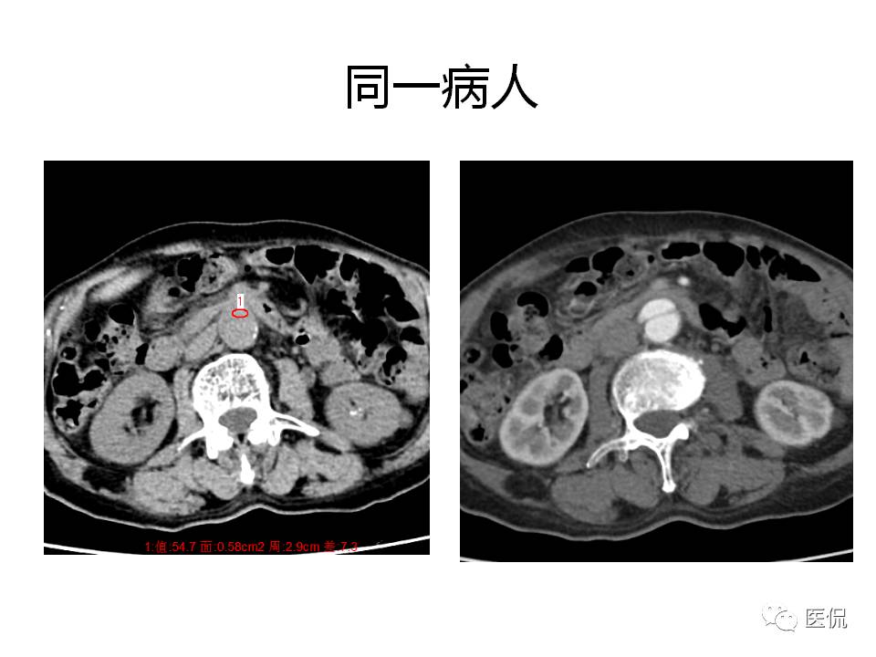 主动脉夹层的影像诊断，这样鉴别更简单！