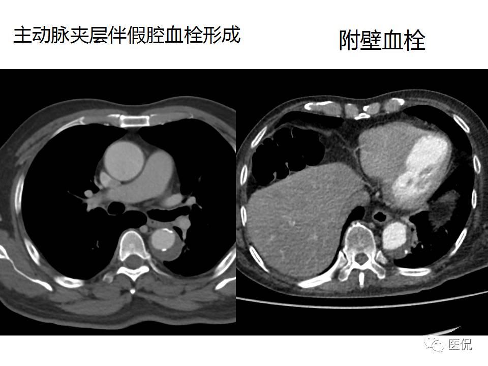 主动脉夹层的影像诊断，这样鉴别更简单！