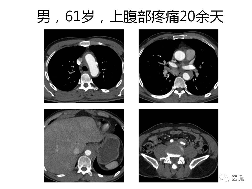 主动脉夹层的影像诊断，这样鉴别更简单！