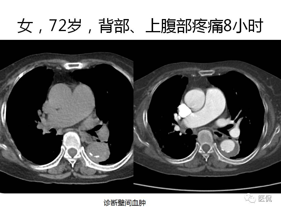 主动脉夹层的影像诊断，这样鉴别更简单！