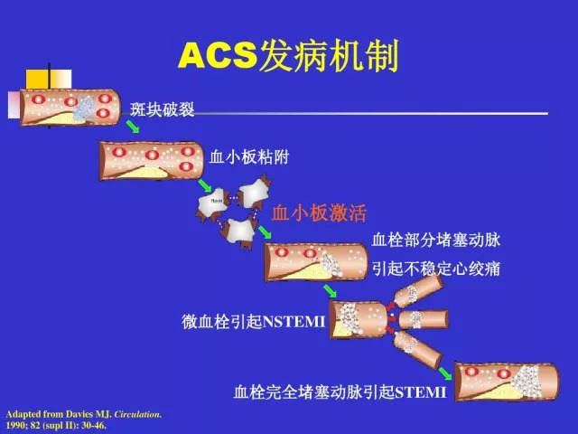 急性心肌梗死的识别