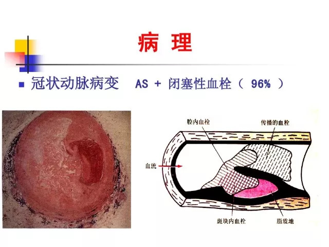 急性心肌梗死的识别