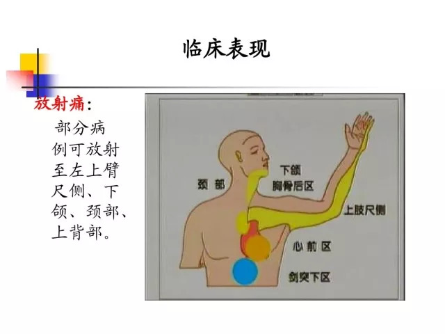 急性心肌梗死的识别