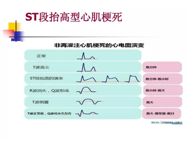 急性心肌梗死的识别