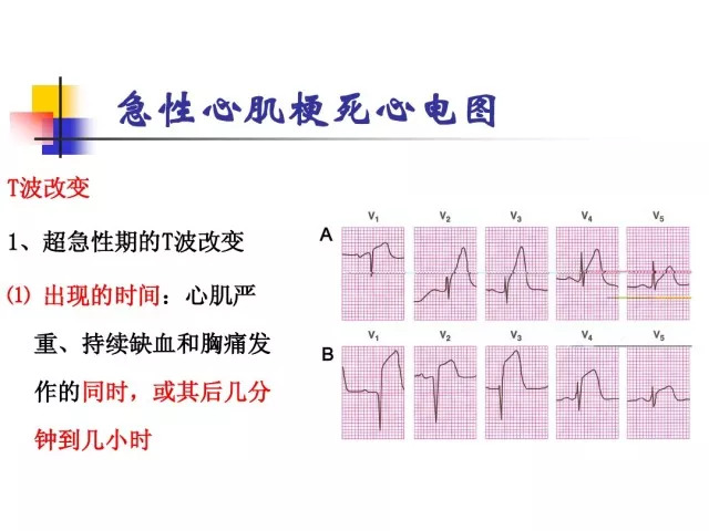 急性心肌梗死的识别