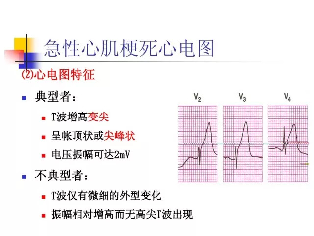 急性心肌梗死的识别