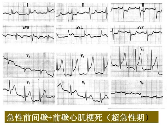 急性心肌梗死的识别