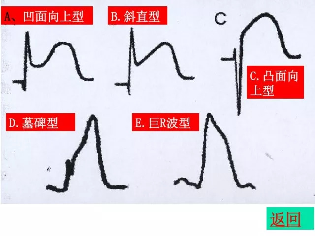 急性心肌梗死的识别