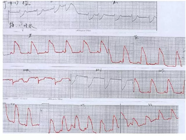 急性心肌梗死的识别