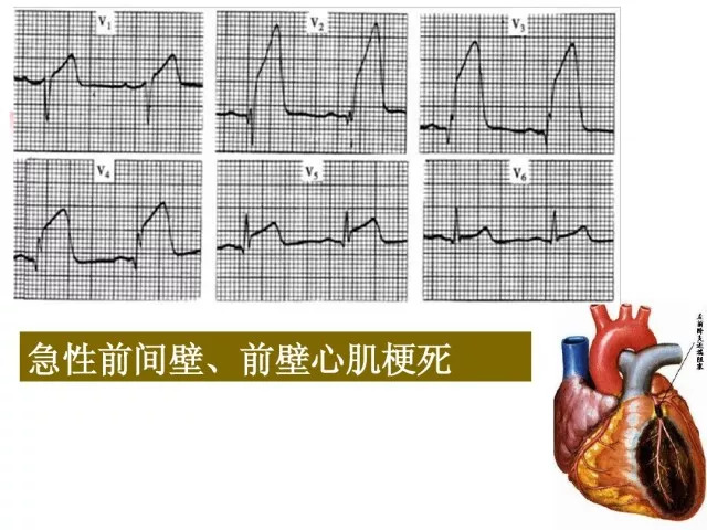 急性心肌梗死的识别