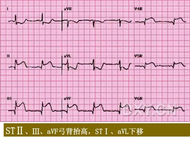 急性心肌梗死的识别
