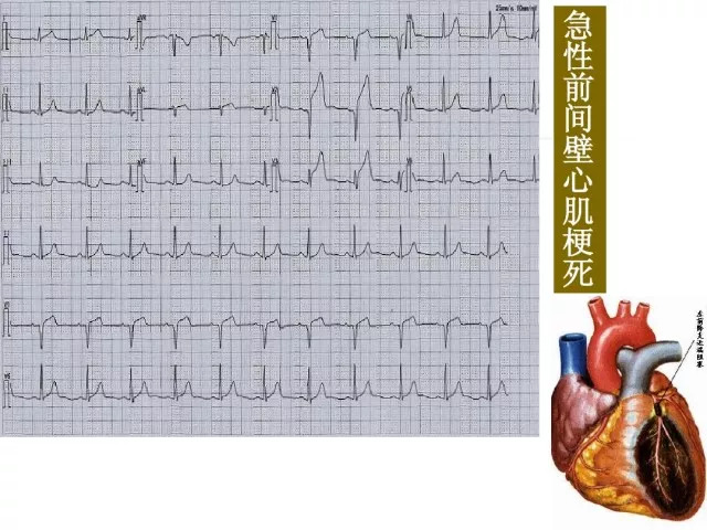 急性心肌梗死的识别