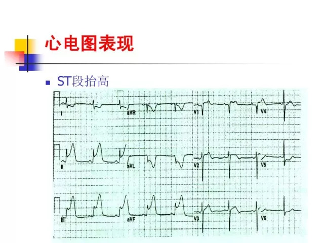 急性心肌梗死的识别