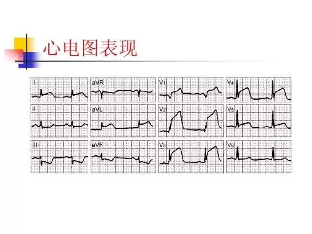 急性心肌梗死的识别