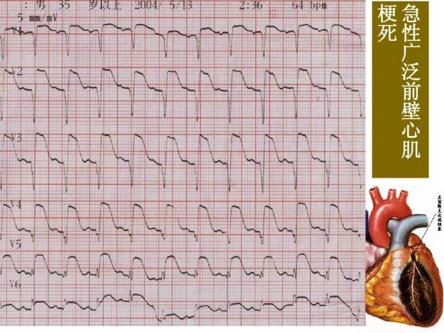 急性心肌梗死的识别