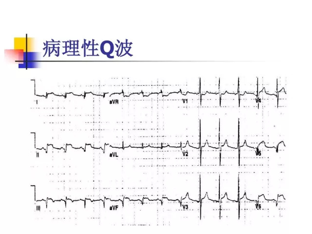 急性心肌梗死的识别