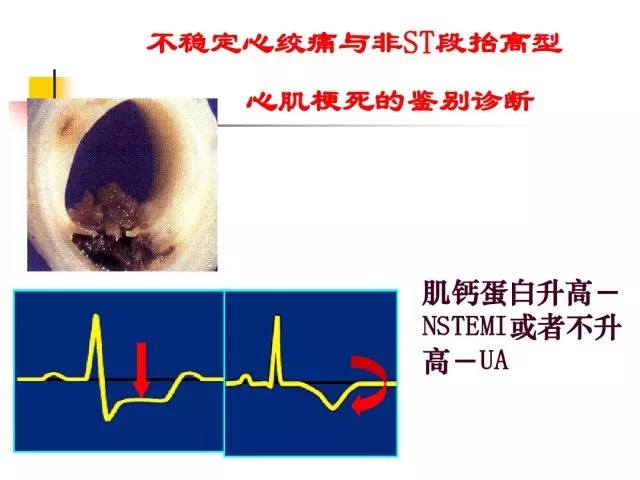 急性心肌梗死的识别