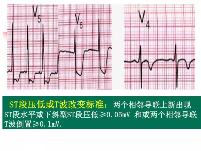 急性心肌梗死的识别