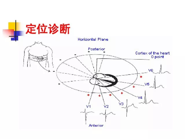 急性心肌梗死的识别