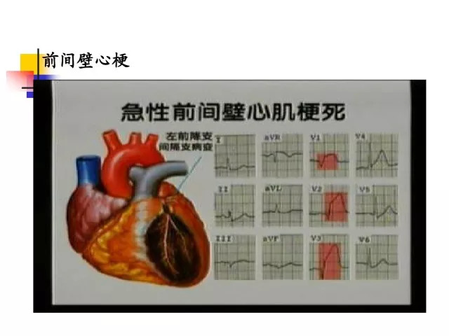 急性心肌梗死的识别