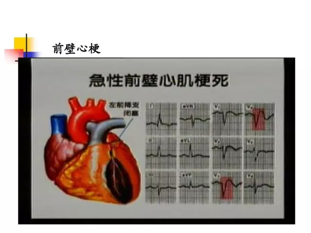 急性心肌梗死的识别