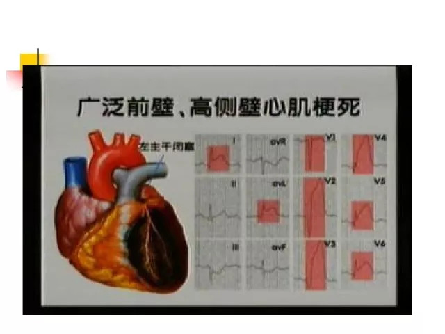 急性心肌梗死的识别