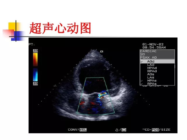 急性心肌梗死的识别