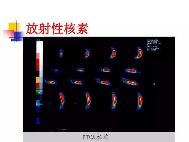 急性心肌梗死的识别