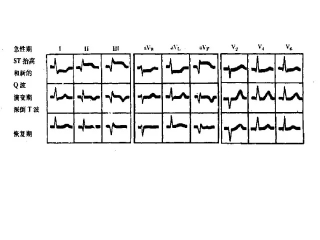 急性心肌梗死的识别