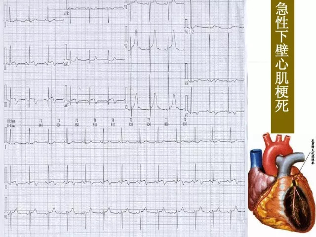 急性心肌梗死的识别