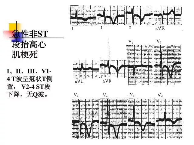 急性心肌梗死的识别