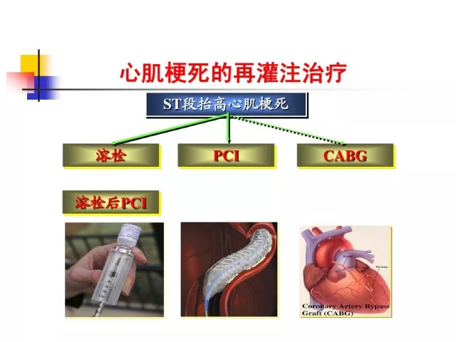 急性心肌梗死的识别