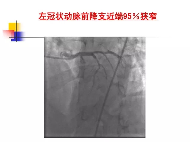 急性心肌梗死的识别