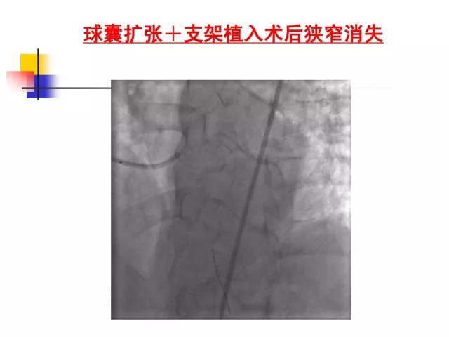 急性心肌梗死的识别