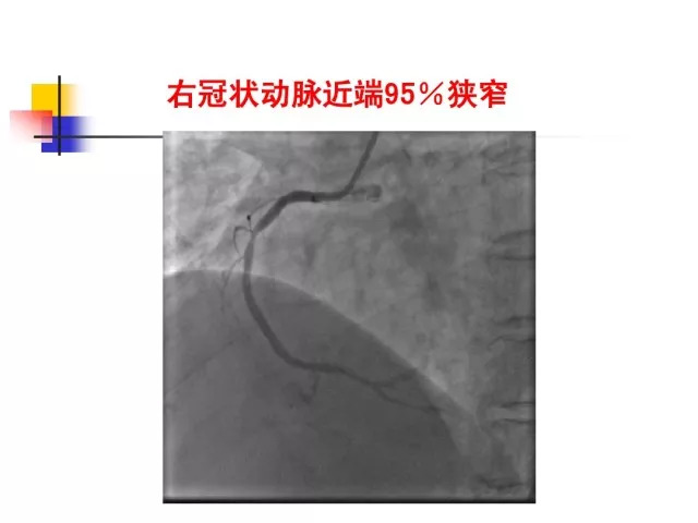 急性心肌梗死的识别