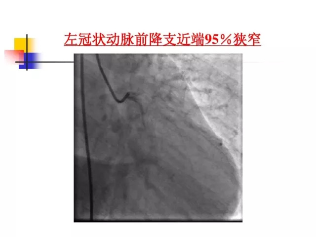 急性心肌梗死的识别