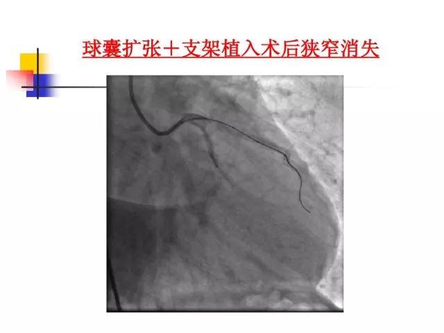 急性心肌梗死的识别