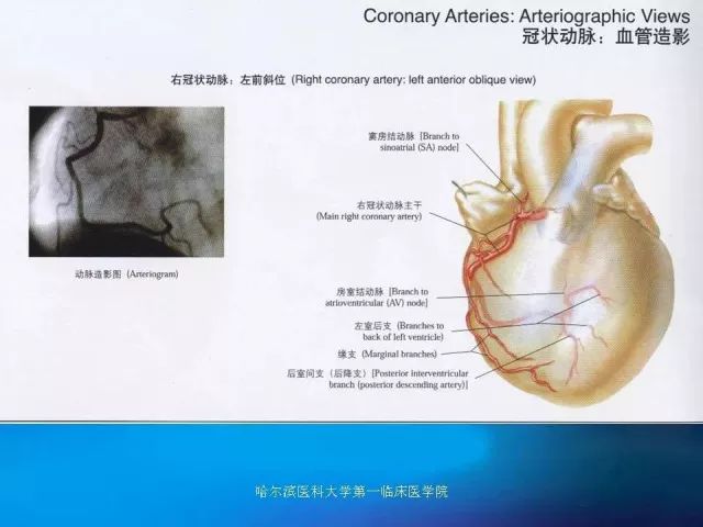 急性心肌梗死的心电图演变