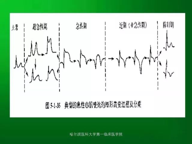 急性心肌梗死的心电图演变