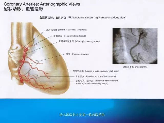 急性心肌梗死的心电图演变