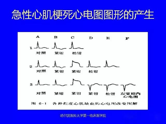 急性心肌梗死的心电图演变