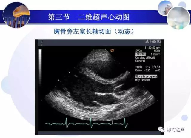 正常心脏超声诊断